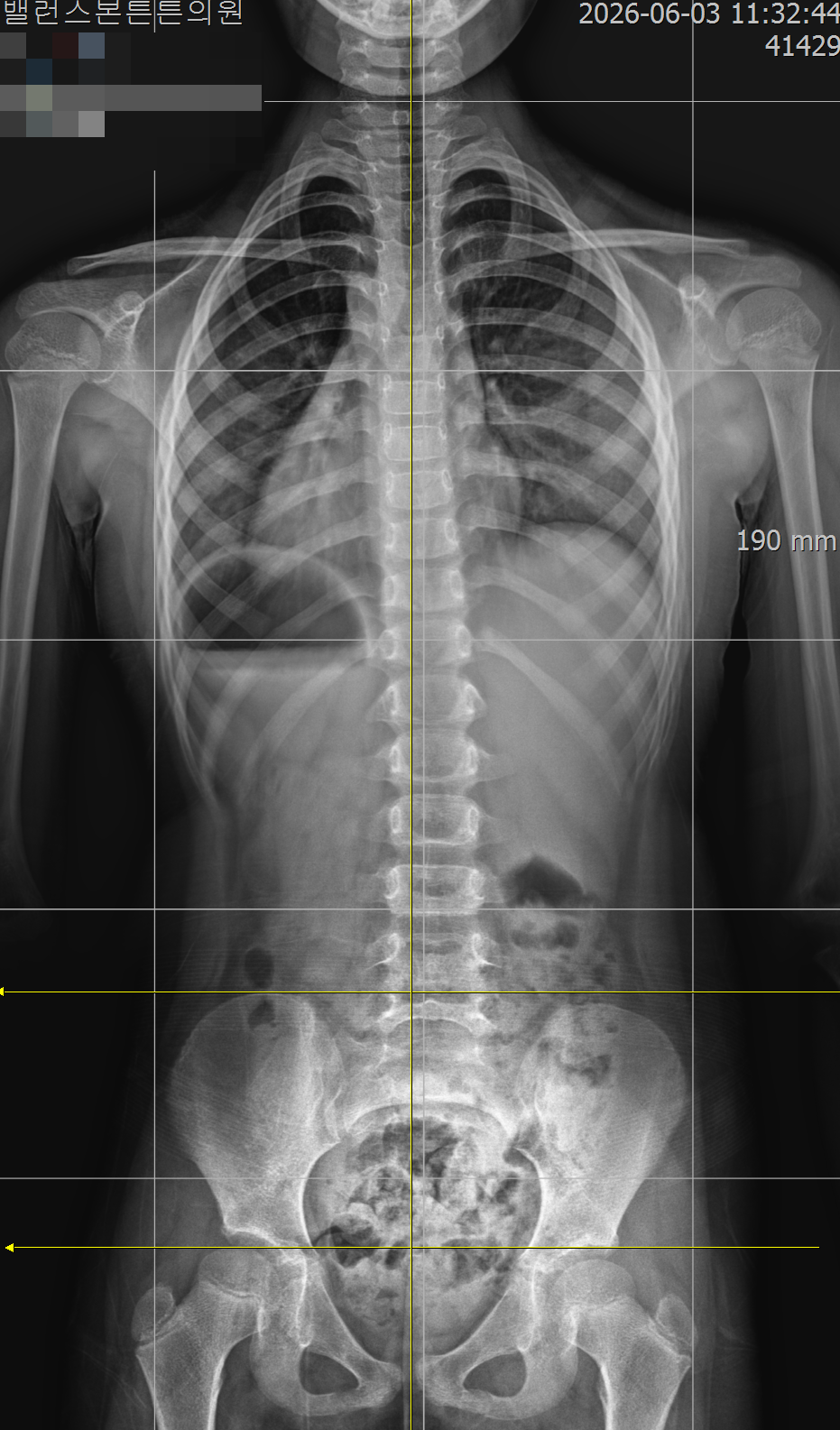 전신 X-ray 정렬 분석