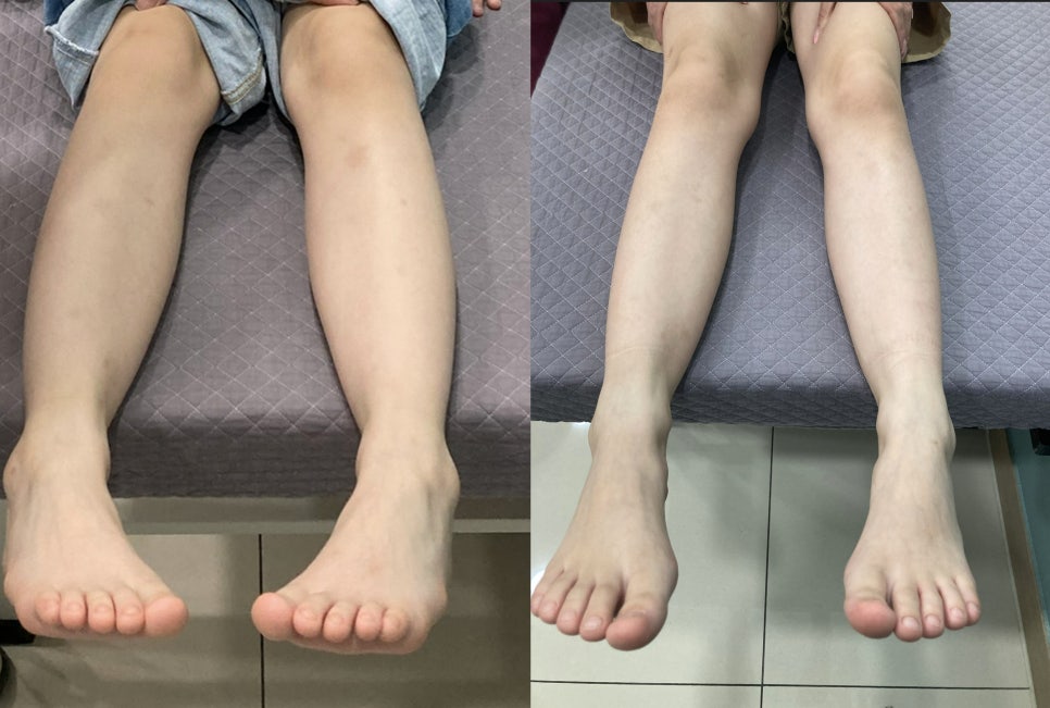 소아 다리 정렬 교정 전후 비교