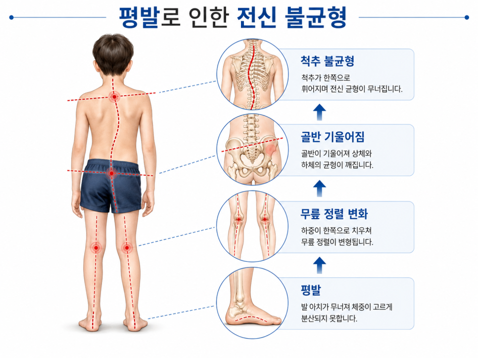 평발로 인한 무릎·골반·척추 연쇄 반응 설명 그림