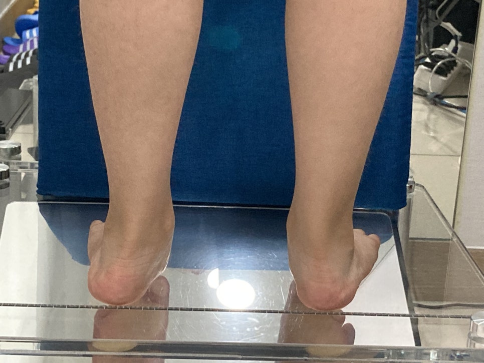 서 있는 상태의 평발 확인