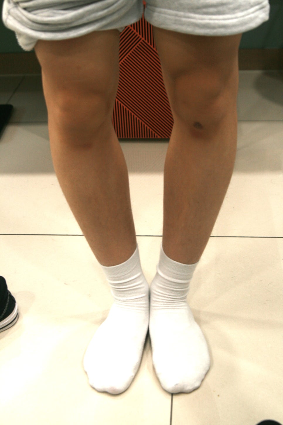 소아 안짱걸음 진료 모습