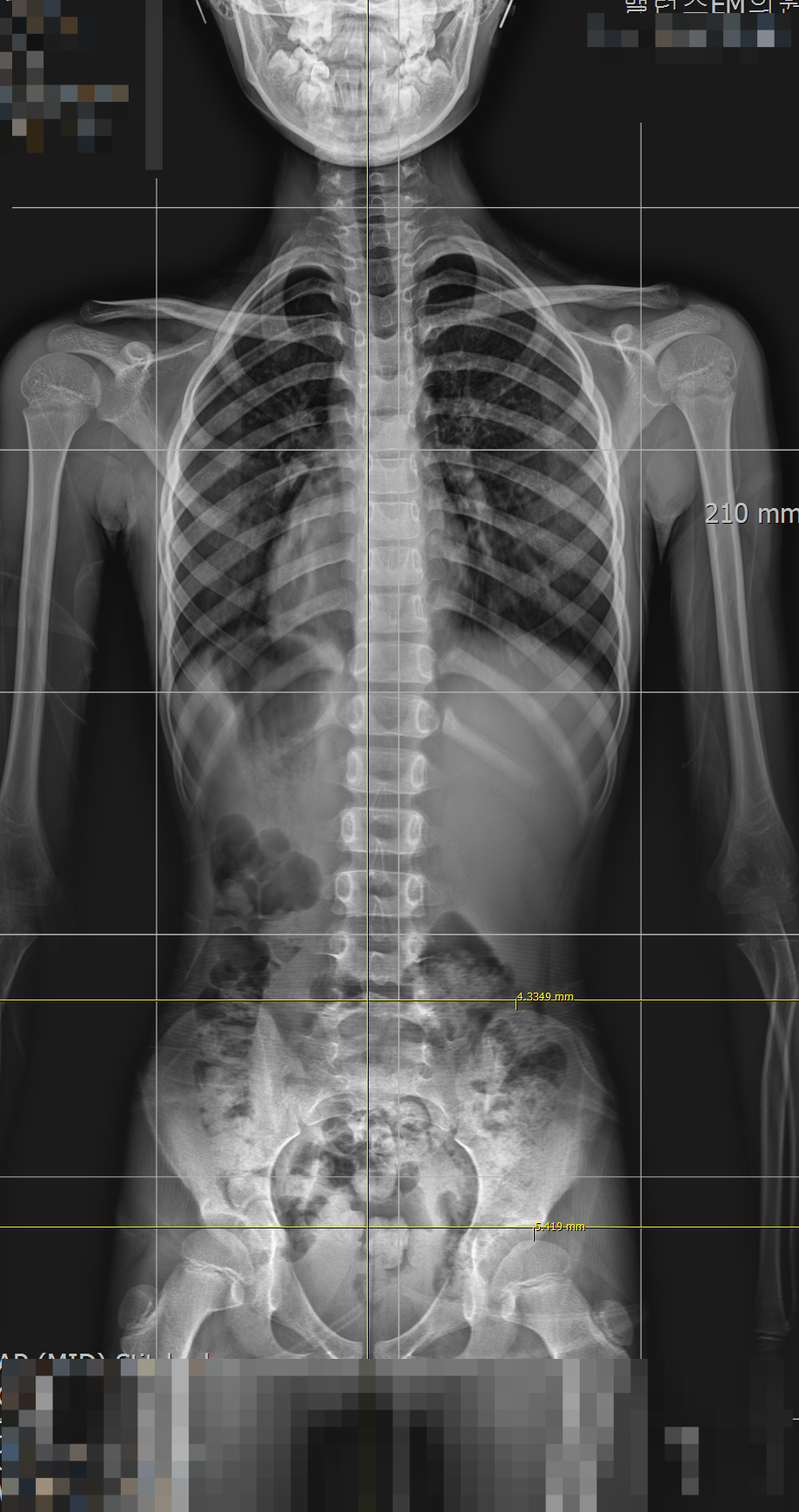 전신 X-ray 분석 사진