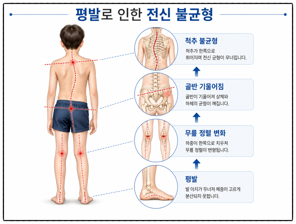 소아평발 검사가 필요한 경우